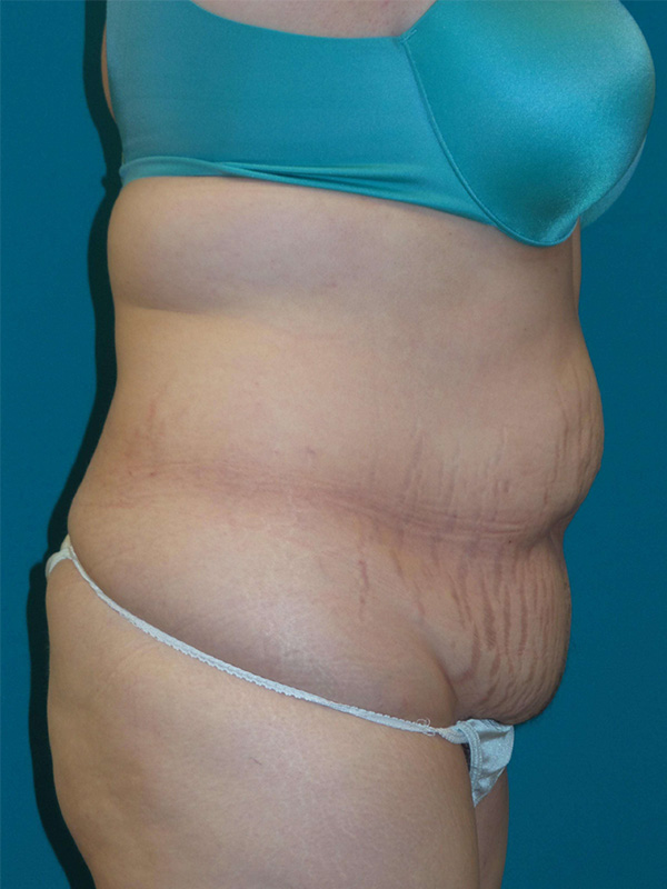 Tummy Tuck Before and After | Princeton Plastic Surgeons