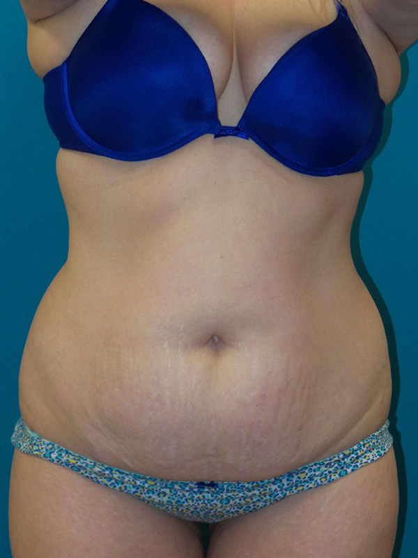 Tummy Tuck Before and After | Princeton Plastic Surgeons