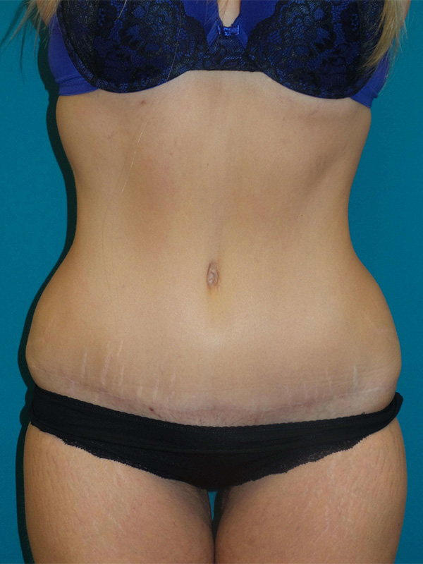 Tummy Tuck Before and After | Princeton Plastic Surgeons