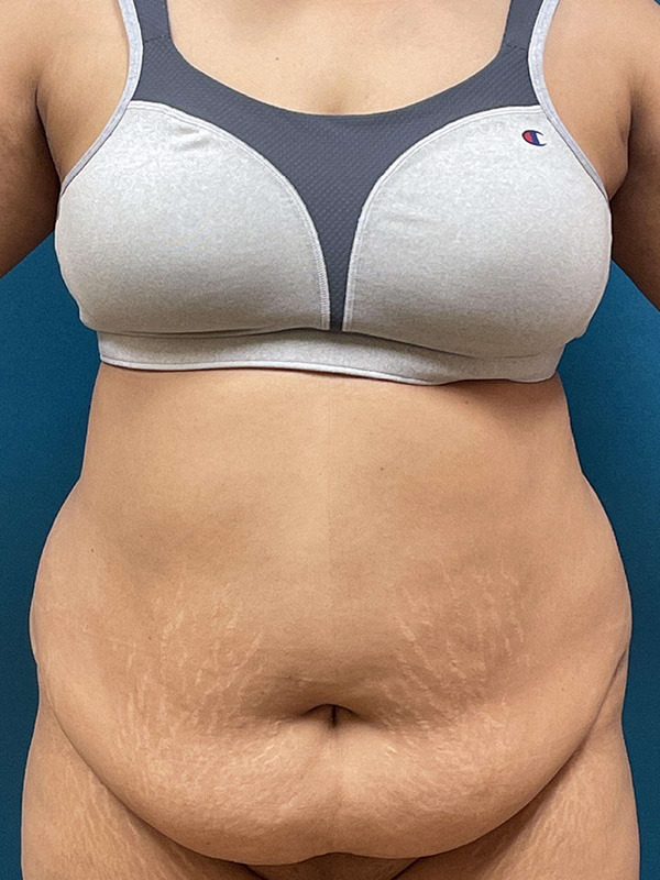 Tummy Tuck Before and After | Princeton Plastic Surgeons