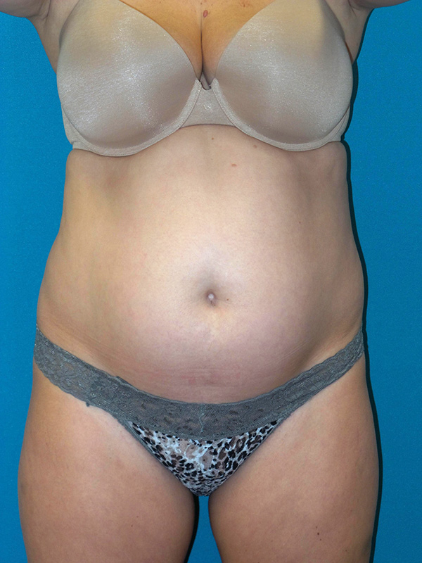 Tummy Tuck Before and After | Princeton Plastic Surgeons