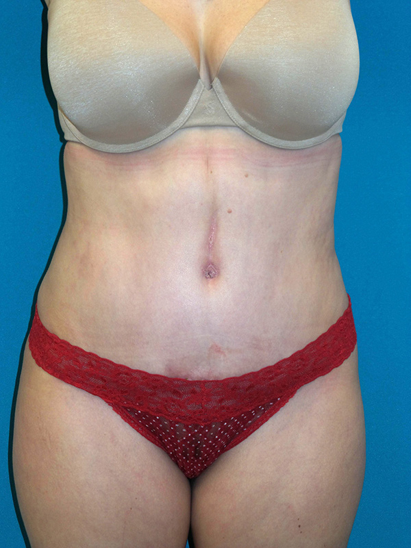 Tummy Tuck Before and After | Princeton Plastic Surgeons