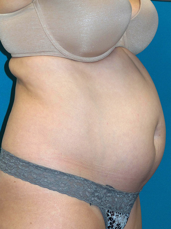 Tummy Tuck Before and After | Princeton Plastic Surgeons