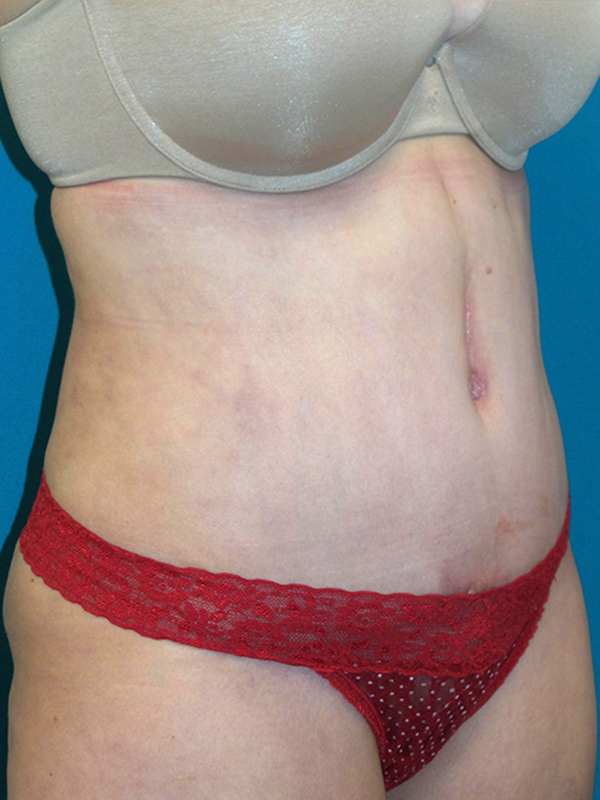 Tummy Tuck Before and After | Princeton Plastic Surgeons