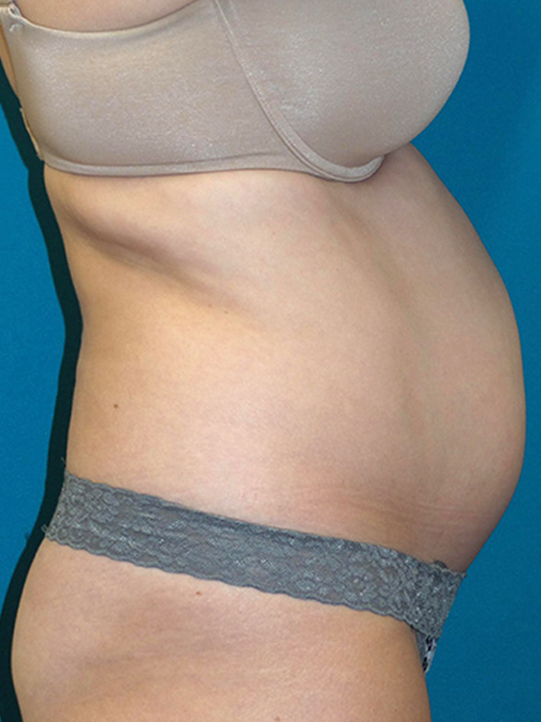 Tummy Tuck Before and After | Princeton Plastic Surgeons