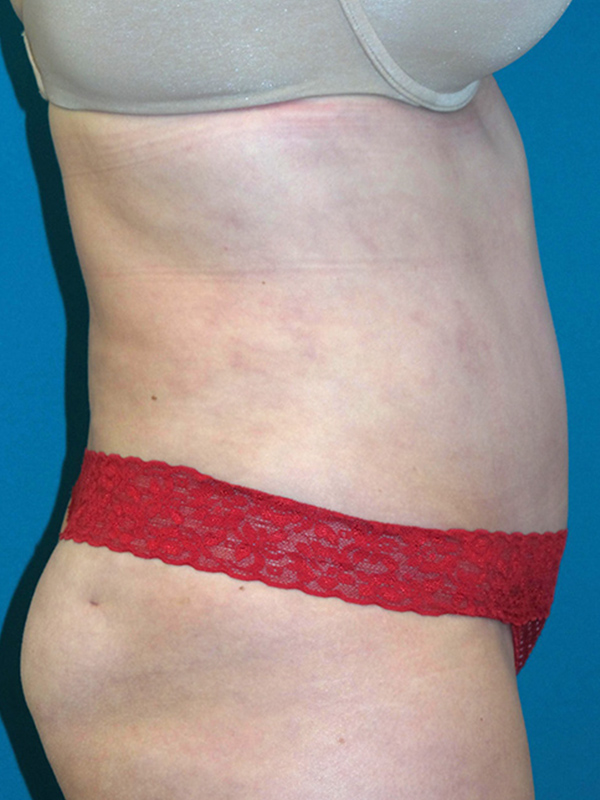 Tummy Tuck Before and After | Princeton Plastic Surgeons