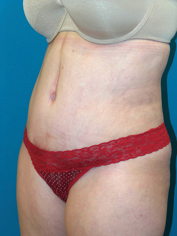 Tummy Tuck Before and After | Princeton Plastic Surgeons