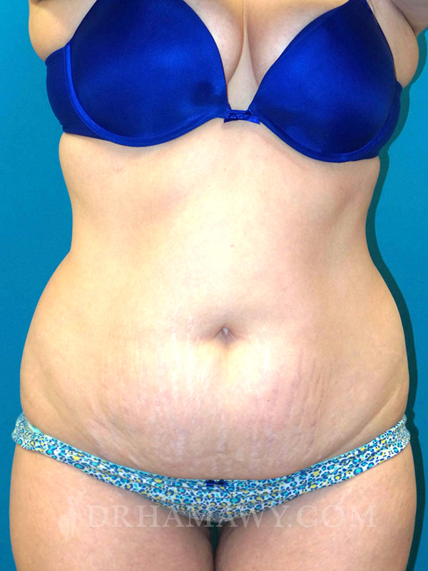 Tummy Tuck Before and After | Princeton Plastic Surgeons