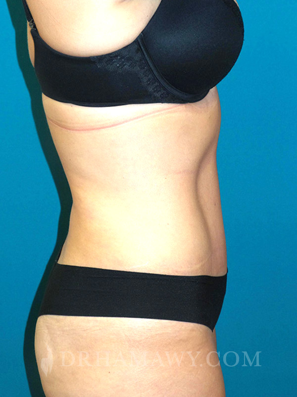 Tummy Tuck Before and After | Princeton Plastic Surgeons