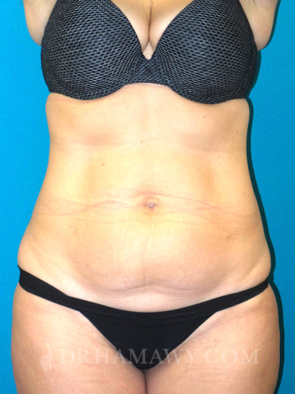 Tummy Tuck Before and After | Princeton Plastic Surgeons