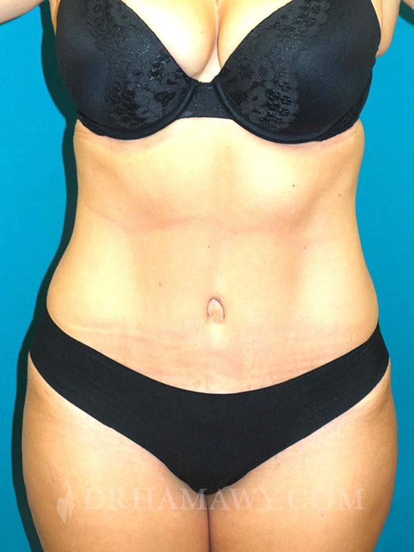 Tummy Tuck Before and After | Princeton Plastic Surgeons