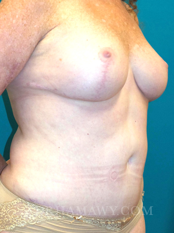 Tummy Tuck Before and After | Princeton Plastic Surgeons