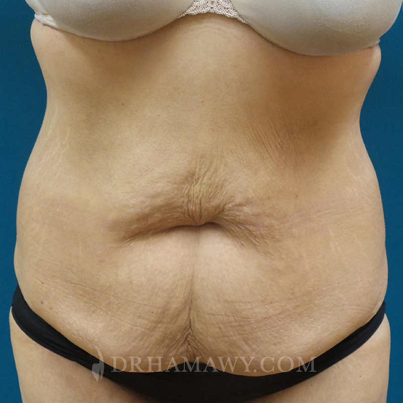 Tummy Tuck Before and After | Princeton Plastic Surgeons