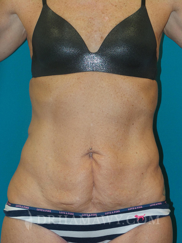 Tummy Tuck Before and After | Princeton Plastic Surgeons