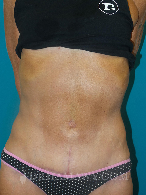 Tummy Tuck Before and After | Princeton Plastic Surgeons