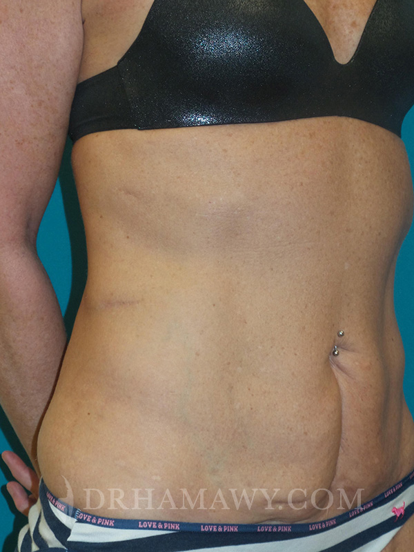 Tummy Tuck Before and After | Princeton Plastic Surgeons