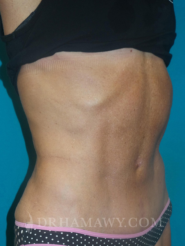 Tummy Tuck Before and After | Princeton Plastic Surgeons