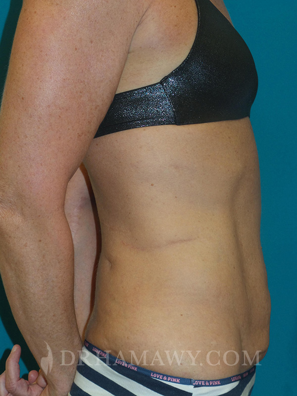 Tummy Tuck Before and After | Princeton Plastic Surgeons