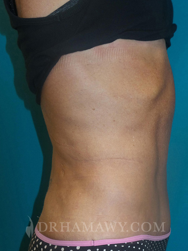 Tummy Tuck Before and After | Princeton Plastic Surgeons