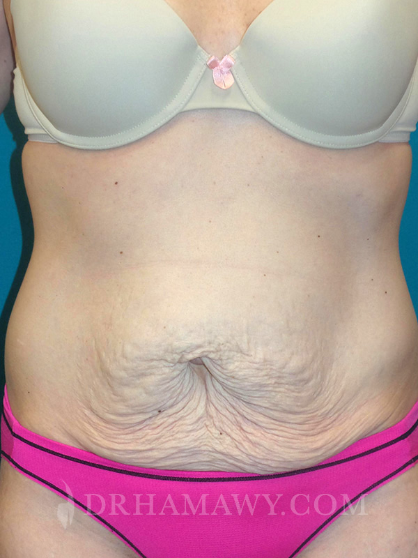 Tummy Tuck Before and After | Princeton Plastic Surgeons