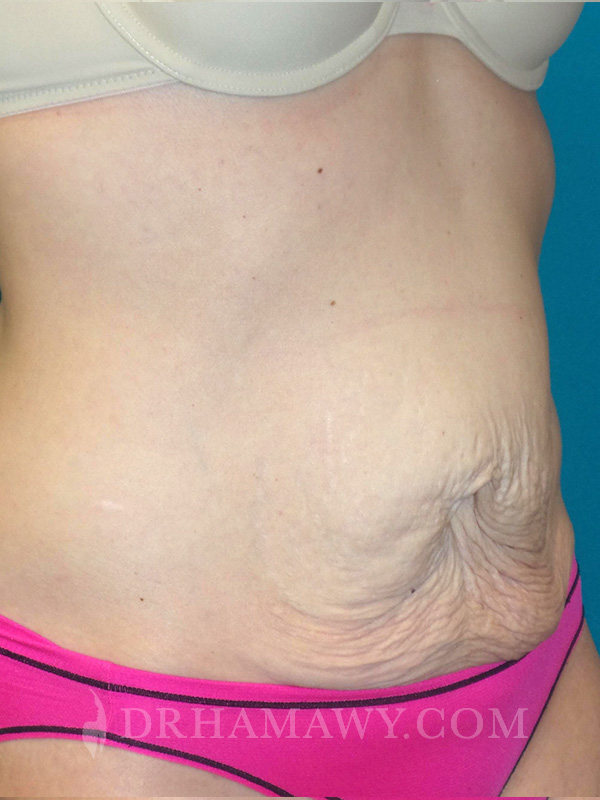 Tummy Tuck Before and After | Princeton Plastic Surgeons