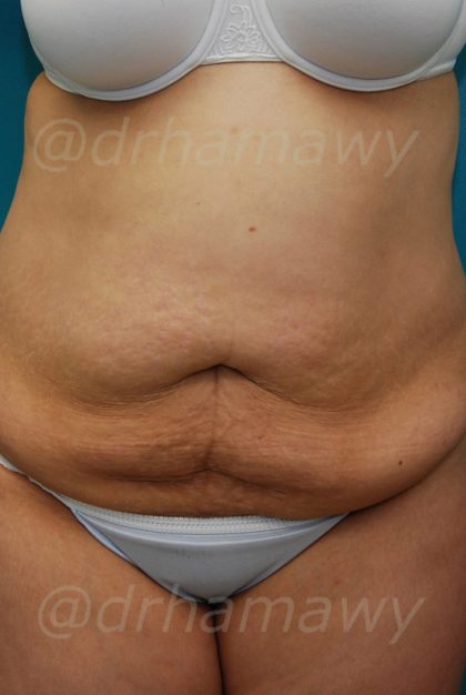 Tummy Tuck Before and After | Princeton Plastic Surgeons