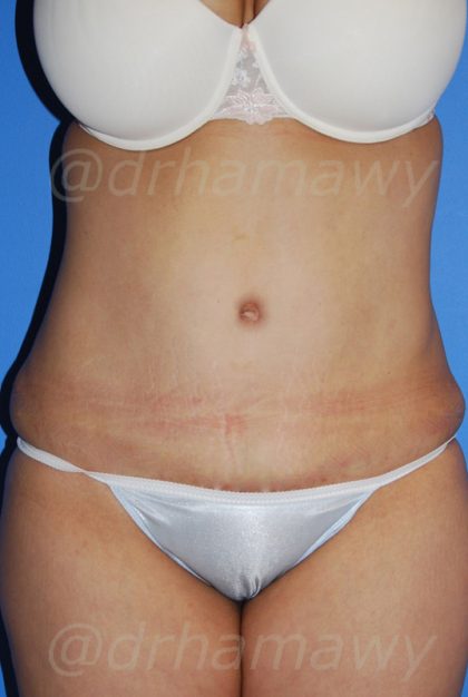 Tummy Tuck Before and After | Princeton Plastic Surgeons