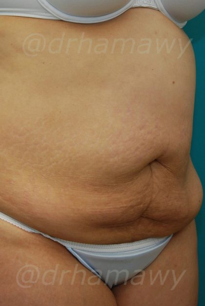 Tummy Tuck Before and After | Princeton Plastic Surgeons