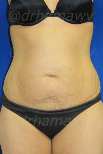 Tummy Tuck Before and After | Princeton Plastic Surgeons