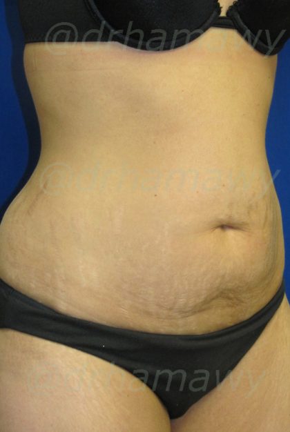 Tummy Tuck Before and After | Princeton Plastic Surgeons