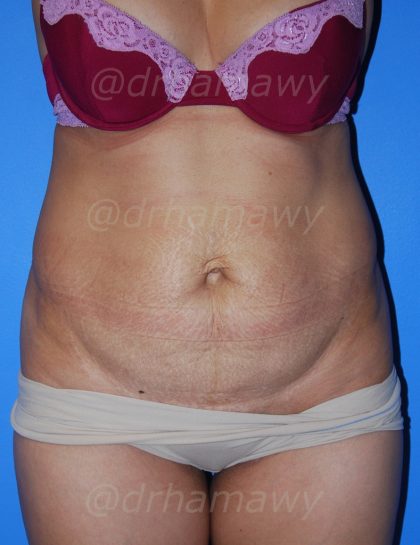 Tummy Tuck Before and After | Princeton Plastic Surgeons