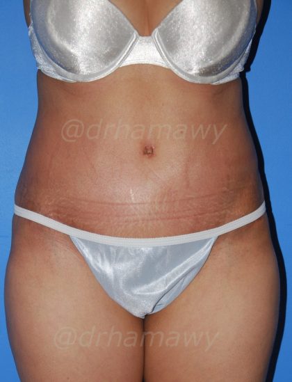 Tummy Tuck Before and After | Princeton Plastic Surgeons