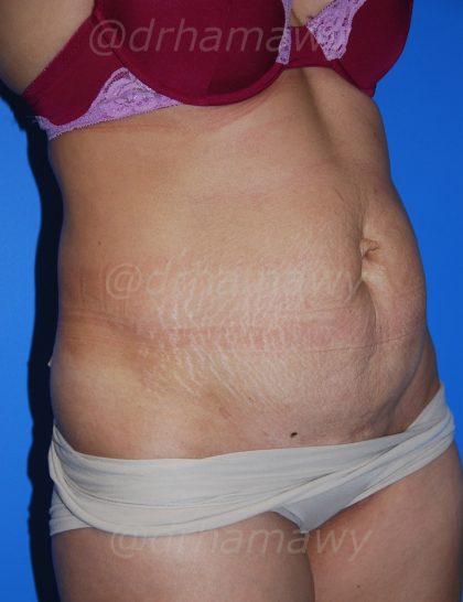 Tummy Tuck Before and After | Princeton Plastic Surgeons