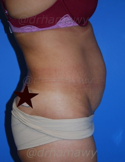 Tummy Tuck Before and After | Princeton Plastic Surgeons