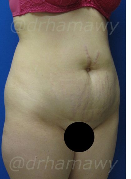 Tummy Tuck Before and After | Princeton Plastic Surgeons