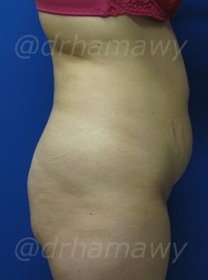 Tummy Tuck Before and After | Princeton Plastic Surgeons