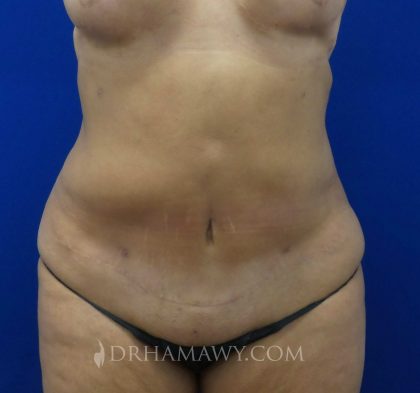 Tummy Tuck Before and After | Princeton Plastic Surgeons