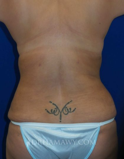 Tummy Tuck Before and After | Princeton Plastic Surgeons