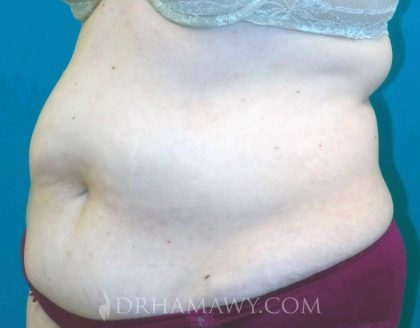 Tummy Tuck Before and After | Princeton Plastic Surgeons