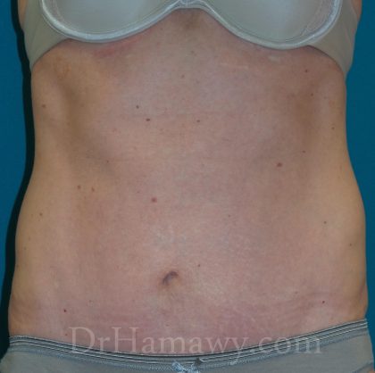 Tummy Tuck Before and After | Princeton Plastic Surgeons