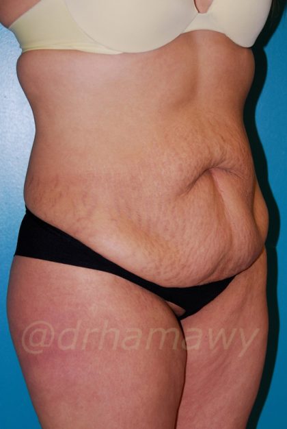 Tummy Tuck Before and After | Princeton Plastic Surgeons