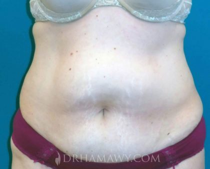 Tummy Tuck Before and After | Princeton Plastic Surgeons