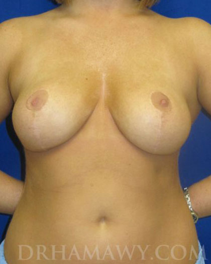 Patient 1 After Breast Reduction - Dr. Hamawy